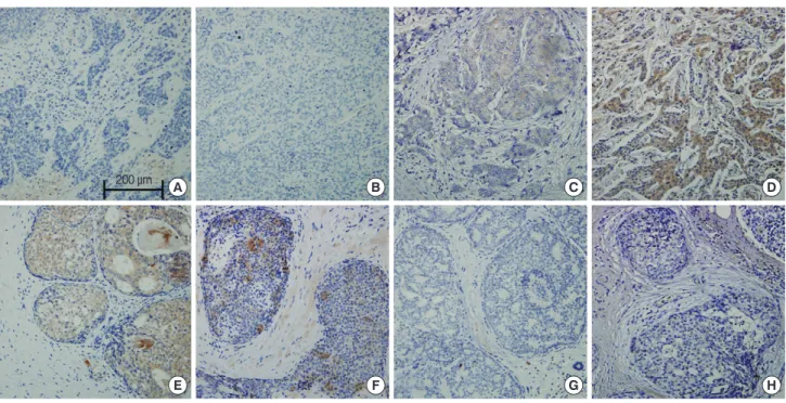 Figure 1. Representative examples of immunohistochemical expression of leptin (A, E), leptin receptor (B, F), adiponectin (C, G), and adiponectin re- re-ceptor (D, H) in invasive ductal carcinoma (upper row) and ductal carcinoma in situ (lower row)