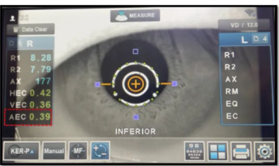 Fig. 1. The measurements of corneal eccentricity        by auto refractometer.