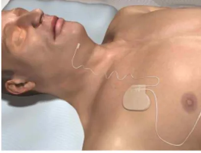 그림 3. Inspire Medical Systems사의 Implantable Neurostimulation Device