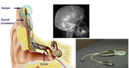 그림 7. EarLens사에서 EarLens Contact Hearing Device 국내의 경우 삼성전자에서 세계 최상위 수준의 디지털 보청기 Multi-core 기반의 DSP Core-chip을 개발하였으나 이에 대한 완제품 출 시는 아직 이루어지지 않고 있다