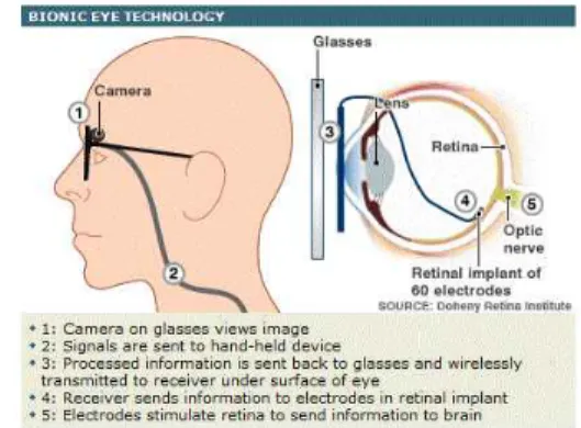 그림 10. Second Sight사의 Argus II Retinal Prosthesis System