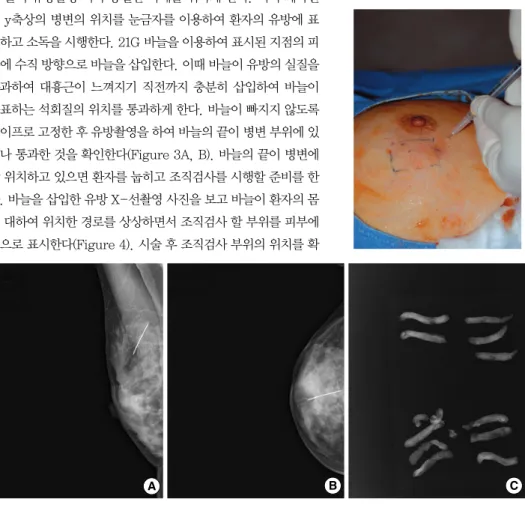 Figure 3. Needle localization vacuum-assisted biopsy. (A, B) After the needle was  in-serted into the lesion, the  pro-per location must be  war-ranted with mammography (lateral and cephalocaudal view)