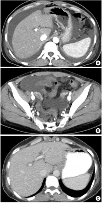 Figure 1. Large amount of ascites in the lower and upper abdo- abdo-men are demonstrated on abdominal computerized tomography scan (A, B)