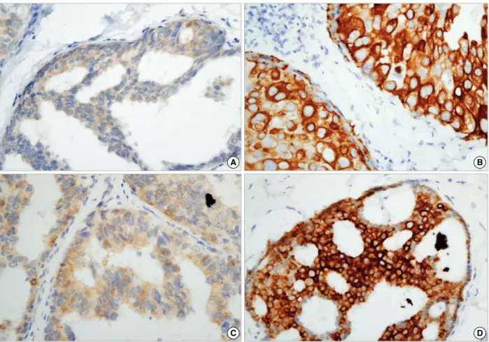 Figure 1. Representative results of phosphorylated Akt (p-Akt) and phosphorylated mTOR (p-mTOR) immunohistochemical staining in samples of ductal carcinoma in situ (×400)