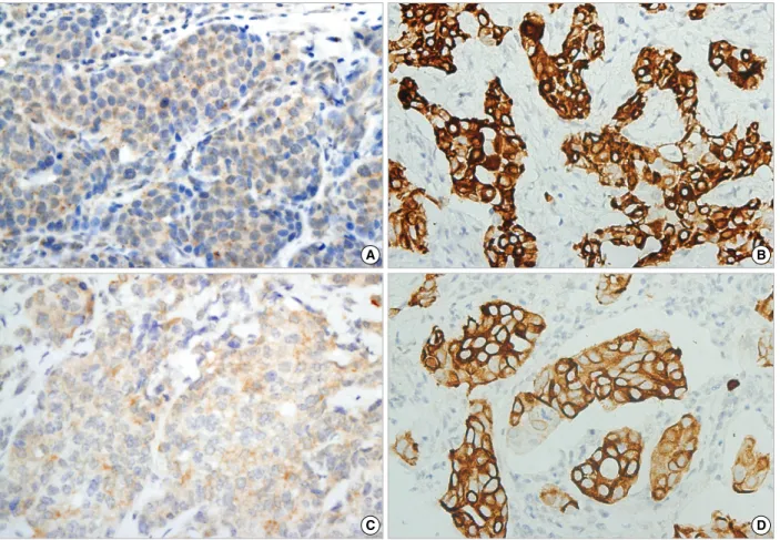 Figure 2. Representative results of phosphorylated Akt (p-Akt) and phosphorylated mTOR (p-mTOR) immunohistochemical staining in samples of invasive ductal carcinoma (×400)