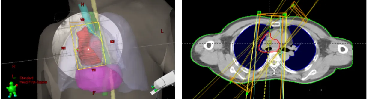 Figure 5. Three dimensional radiation therapy planning by using multiple beams while avoiding the  spinal cord, lung, and heart which can make treatment possible with less dose of radiation exposed  to the normal tissues.