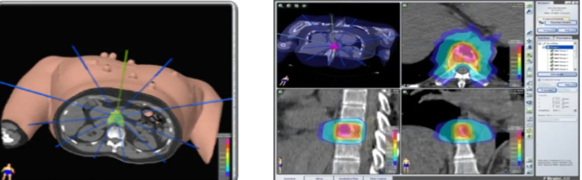 Figure 3. The patient with spine metastasis was treated with stereotactic body radiation therapy, by  using multiple beams while avoiding the spinal cord, which can make treatment possible with less  dose of radiation exposed to the normal tissue and more 