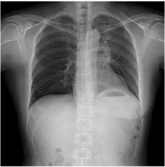 Figure 3. Flexible bronchoscopy shows obstruction of left upper lobar bronchus with hyperemic mucosal change.