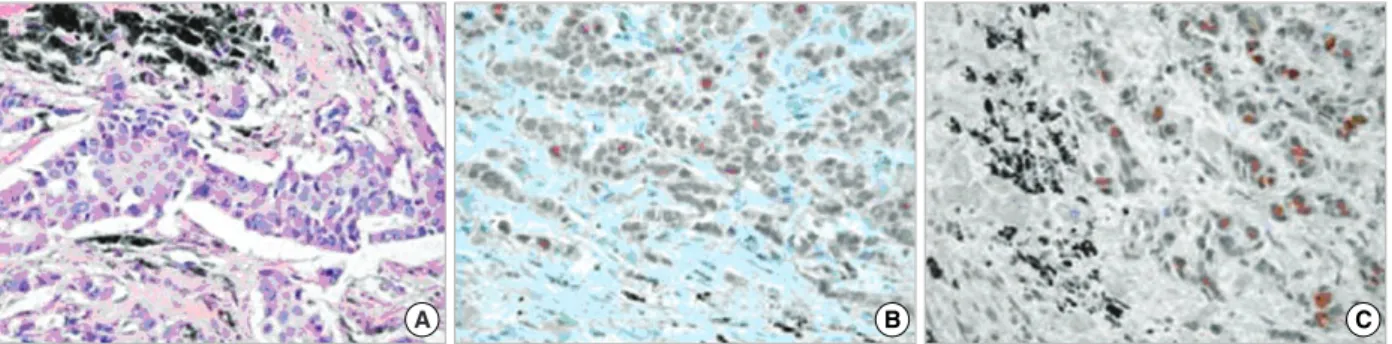 Figure 4. Microscopic examinations of bronchoscopic biopsy specimen shows pleomorphic, poorly differentiated carcinoma (A, H&amp;E stain, ×400)