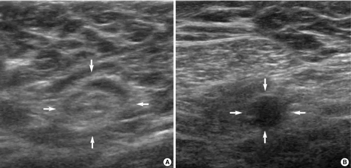 Figure 1. The ultrasonographic findings of axillary lymph node. (A) The reactive lymph node has shown a oval shape, smooth contour, hyperechoic central hilum (arrows)