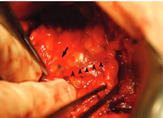 Figure 1. Identification of a blue ARM node (arrow) in relation with the lymphatic drainage (arrowheads) from arm in the axilla