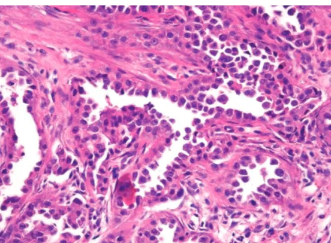 Figure 1. Breast sonography. (A) A 1.2 cm sized mass is noted in the 12 o’clock direction in the left breast