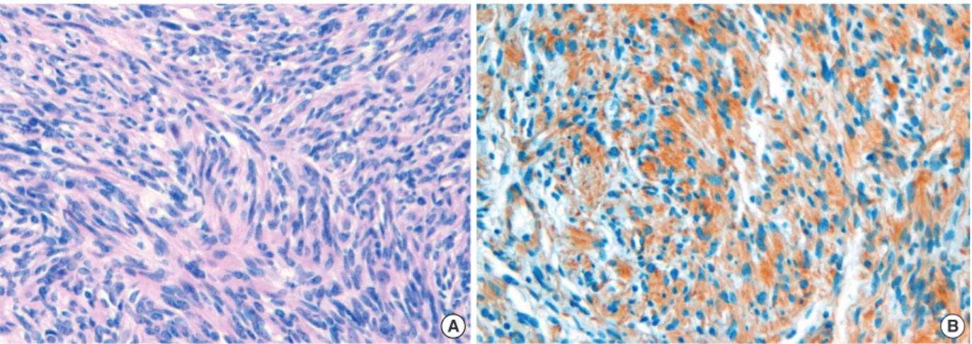 Figure 4. Microscopic finding of H&amp;E and immunohistochemical staining. (A) This area shows more dense fascicles of spindle cells (H&amp;E stain,  × 200)
