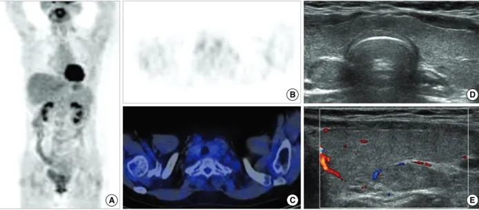 Figure 1. A case of diffusely increased F-18 FDG uptake, but less than activity of mediastinal blood pool, in the thyroid gland of 55-yr- 55-yr-old patient