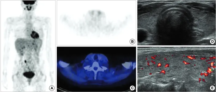 Figure 2. A case of diffusely increased F-18 FDG uptake, similar intensity with mediastinal blood pool, in the thyroid gland of 46-yr-old patient