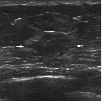 Fig 2. 71-yr-old woman with a palpable cancer. US demonstrates a microlobulated, irregular shaped, hypoechoic mass (arrows) that is not parallel to the skin