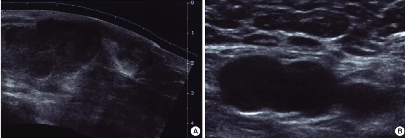 Fig 1. The ultrasonographic findings of malignant fibrous histiocytoma. Several large hypoechoic &amp; isoechoic masses are noted in lower half of right breast and part of them are located in subcutaneous layer (A) and lymph nodes in right axilla are enlar
