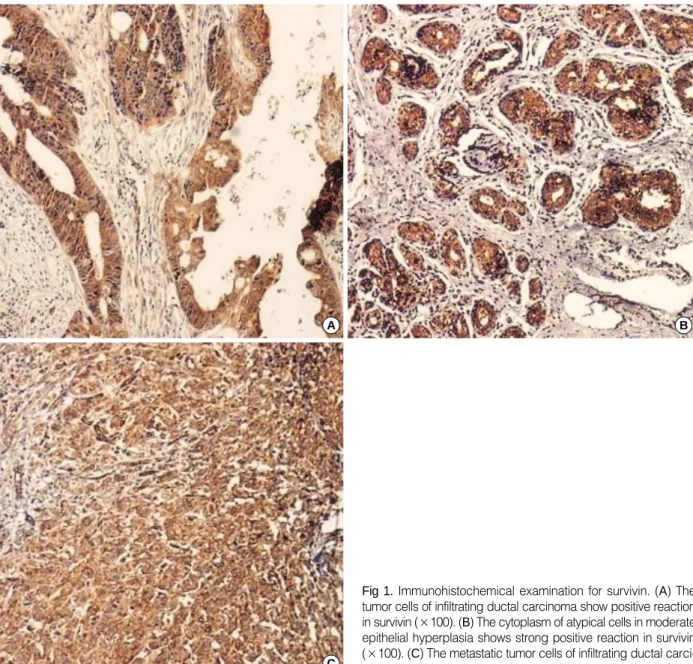 Table 2. Cytoplasmic survivin expression in breast carcinoma