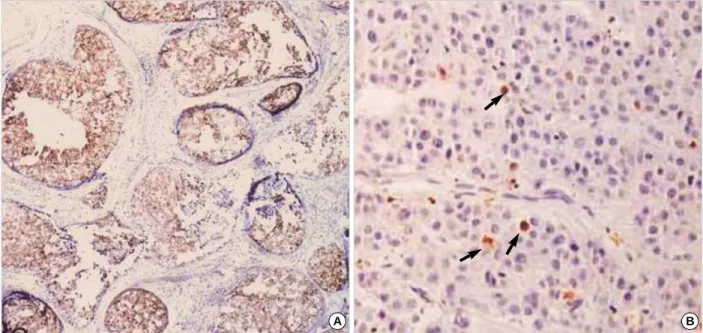 Table 4. Expression of bcl-2 and p53 in survivin positive breast cancer Survivin expression Negative (%) Positive (%) p-value bcl-2 expression 0.015 Positive 23/56 (41.1) 33/56 (58.9) Negative 14/24 (58.3) 10/24 (41.7) p53 expression 0.271 Positive 8/18 (4