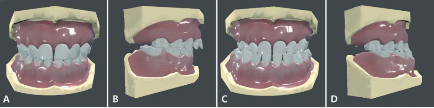 Fig. 1. Virtual malocclusion models. (A) Frontal view of Class II malocclusion model. (B) Right view of Class II malocclusion  model