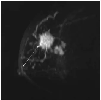 Fig 1. 3-D reconstructive MR imaging of the breast in a patients with infiltrating ductal carcinoma