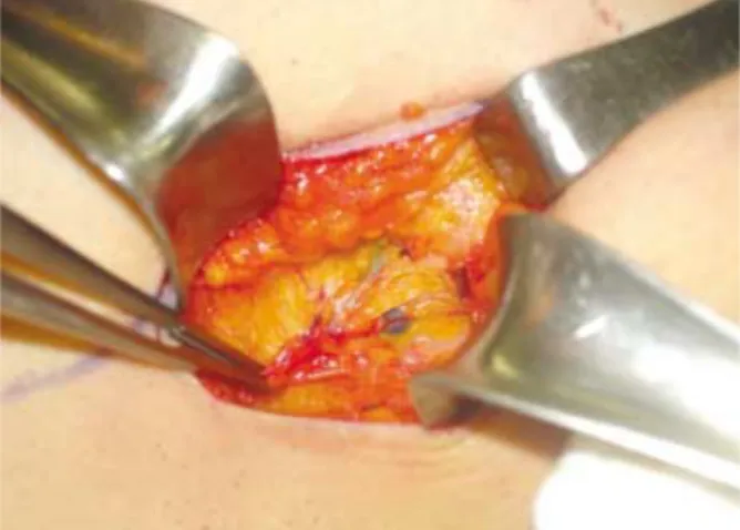 Fig 1. Stained lymphatics and lymph node during sentinel lymph node biopsy.