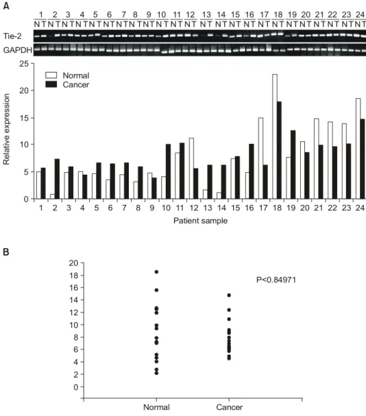 Fig.  2.  The  Tie-2  gene  expression  in  human  breast  carcinoma.  (A)  Expression  of  the  Tie-2  and  G3APDHin  22  patients  with  invasive  ductal  breast  cancer,  determined  by  RT-PCR