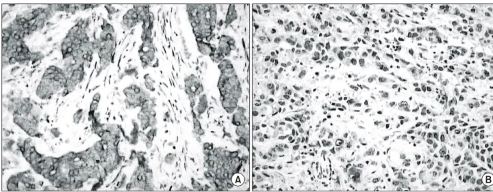 Fig.  1.    Immunohistochemical  expression  of  bcl-2  (A:  ×100)  and  apoptosis  (B:  ×100).