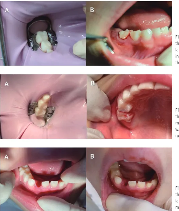 Fig. 7. Resin restorations of  the right deciduous maxillary  molars.	(B)	Gingival	bleeding	 was	seen	after	removal	of	the	 rubber	dam