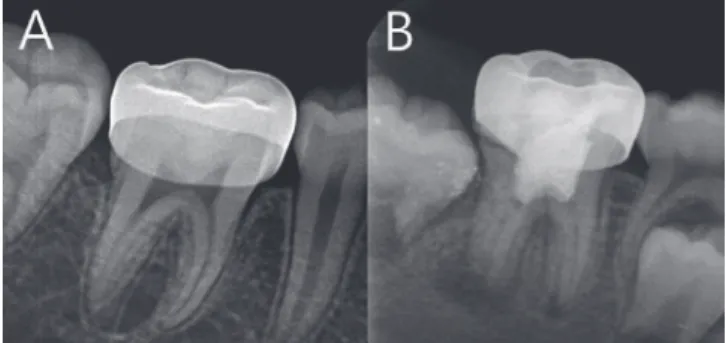 Fig. 1. (A) A successful preformed metal crown restoration. 