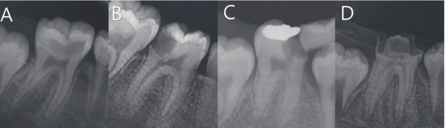 Table 1. Reasons for failure of preformed metal crowns in perma- perma-nent first molars