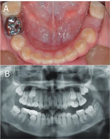 Fig. 8. Panoramic radiograph showed horizontal impaction  of the permanent mandibular left first molar with primary  retention of the primary mandibular left second molar