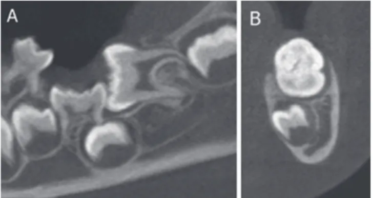Fig. 10. A lingual button was attached to the permanent  mandibular left first molar for orthodontic traction.