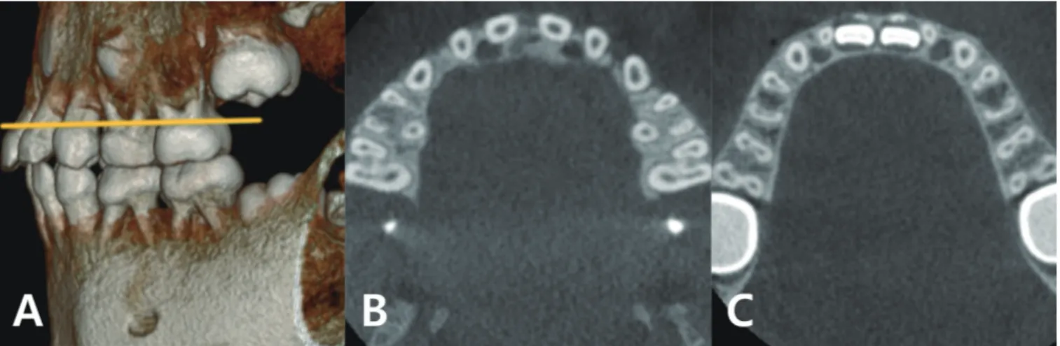 Fig. 1. Number of roots and root canals of primary molars, measured at the cervical area (Axial view)