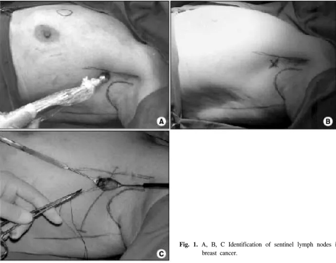 Fig.  1.  A,  B,  C  Identification  of  sentinel  lymph  nodes  in  breast  cancer.