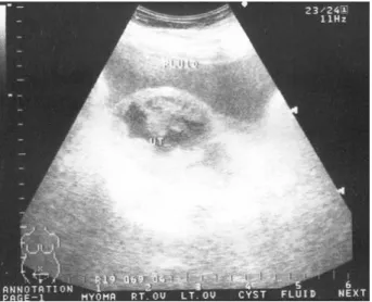 Fig.  1.  Transvaginal  sonogram  of  case  #1.  A  6.7×4.3  cm  sized  mass  with  internal  cavity  was  noted  in  the  uterus