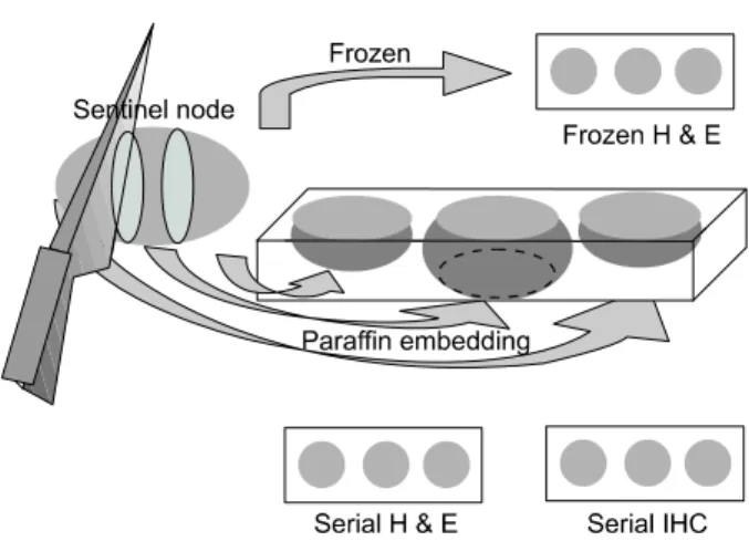 Fig.  1.  Pathologic  evaluation  of  sentinel  lymph  node.  Sentinel  node  was  divided  into  3  fragments  equally