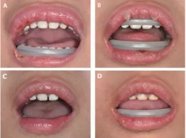 Fig. 4. Orthodontic tube and bracket before (A) and after  simplification (B).