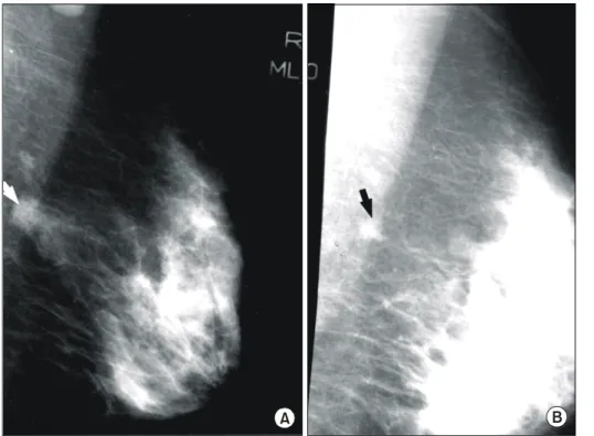 Fig.  3.  Mammogram  of  47-year-old  female  with  invasive  ductal  carcinoma  and  nodal   involve-ment