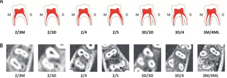 Table 1 and 2 show the types of root and canal in primary 