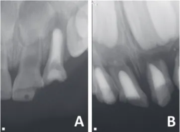Fig. 2. Periapical radiographs of primary maxillary anterior  teeth. (A, B) The teeth were treated for periapical abscess at  the age of 1 year and 4 years, respectively