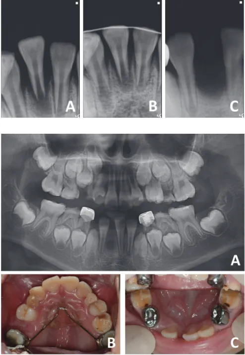 Fig. 3. Tooth missing from self-mutilation  of mandibular central incisor. (A, B)  Self-luxated right mandibular central incisor  was splinted to adjacent teeth at the age  of 5 years