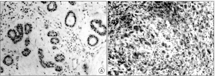 Fig.  1.  Immunohistochemistry  for  estrogen  receptor  in  primary  tumor  (A)  and  lymph  node  (B)