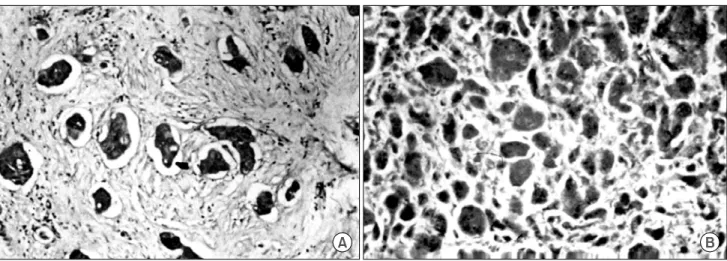Fig.  3.  Immunohistochemistry  for  c-erbB2  in  primary  tumor  (A)  and  lymph  node  (B)