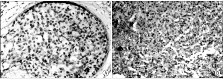 Table  1.  Comparison  of  histologic  grade  between  primary  tumor  and  lymph  node  (LN)