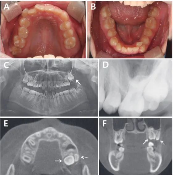 Fig. 1. At first examination. The line arrows represent the maxillary left 2nd molar and the dotted arrows represent the su- su-pernumerary tooth
