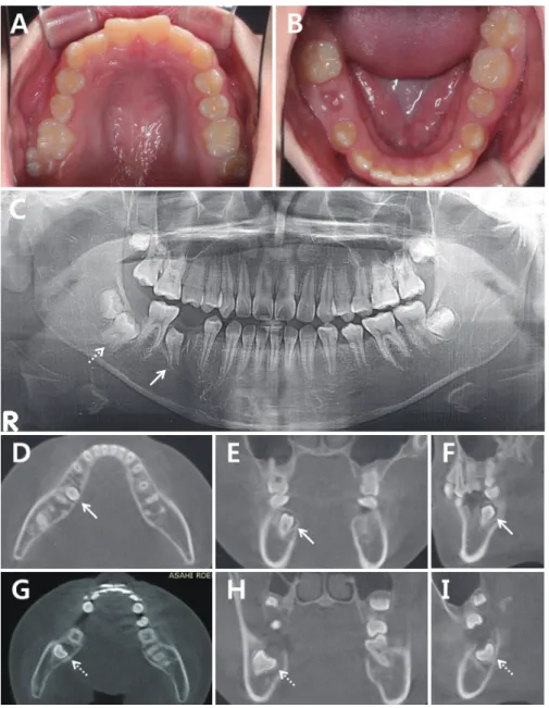Fig. 5. At first examination. The line arrows represent the mandibular right 2nd premolar and the dotted arrows represent  the mandibular right 2nd molar