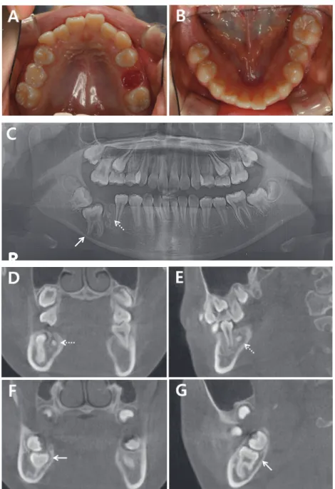 Fig. 9. At first examination. The line arrows represent the mandibular right 1st molar and the dotted arrows represent  odontoma