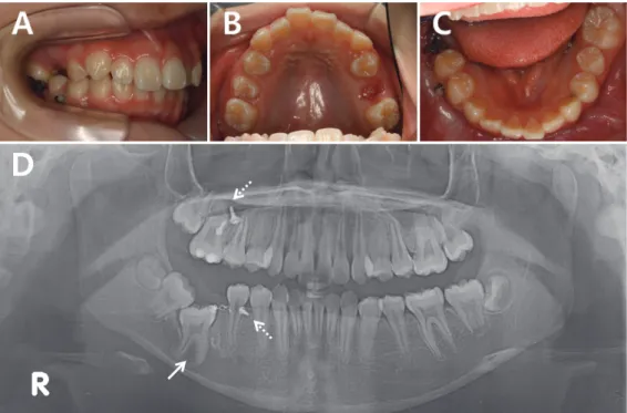 Fig. 11. At 6 months after traction. The mesial movement  of the mandibular right 1st molar was completed.
