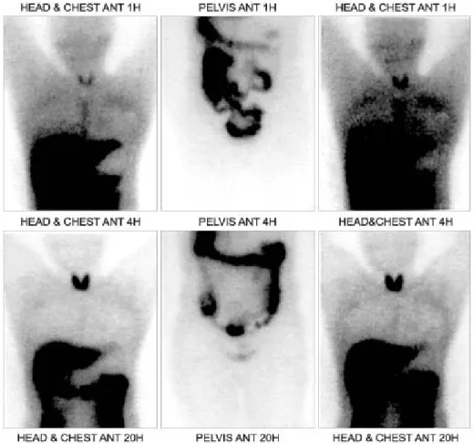 Fig.  1.  Normal  I-123  estradiol  scinti- scinti-graphy  (1  hour  after  injection  of  I-123  estradiol).